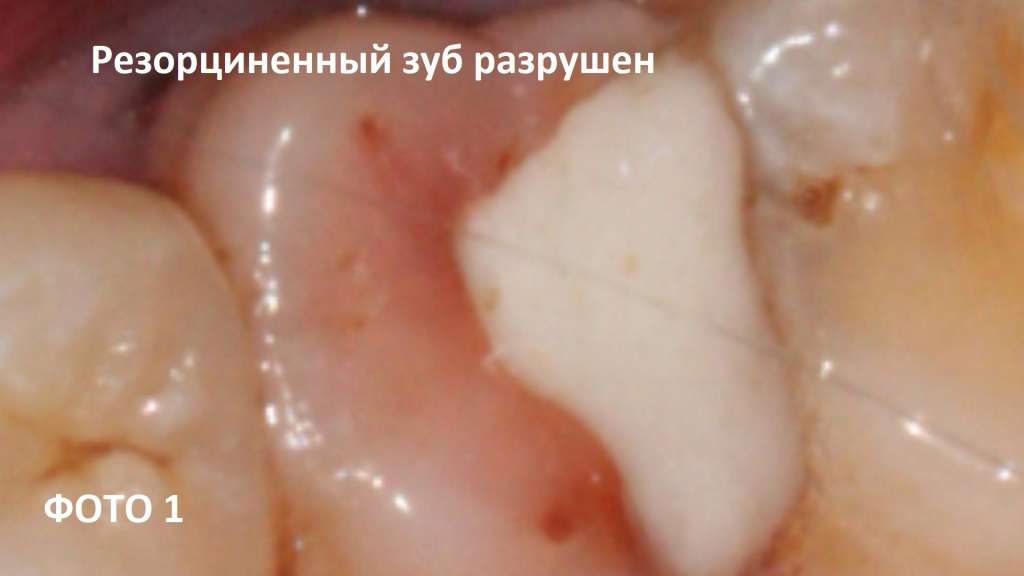 Зуб ранее эндодонтически лечен резорцин-формалиновым методом